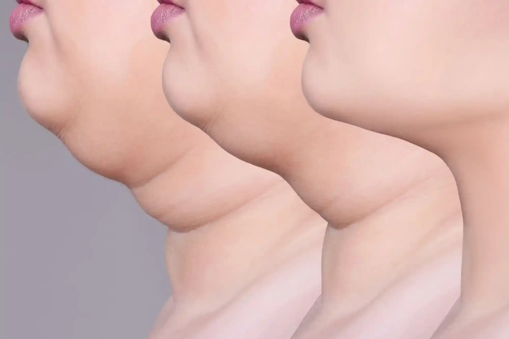 هل تعاني من الذقن المزدوج وتريد التخلص منه نهائياً في دبي؟